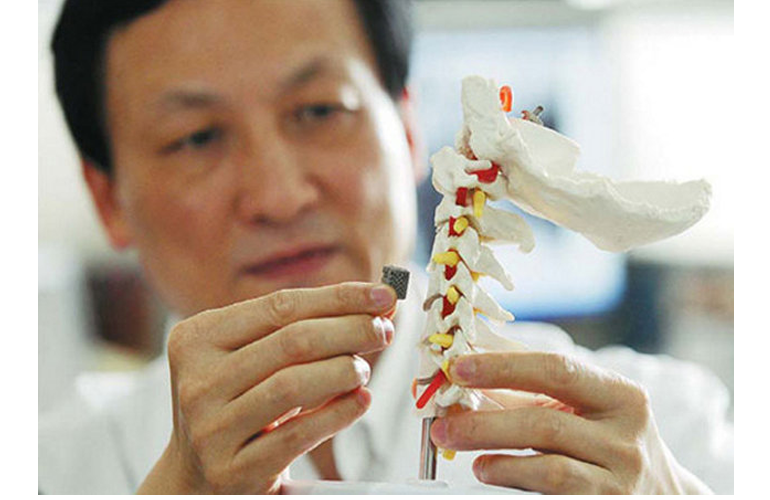 Implantan en China la primera vértebra elaborada con una impresora 3D