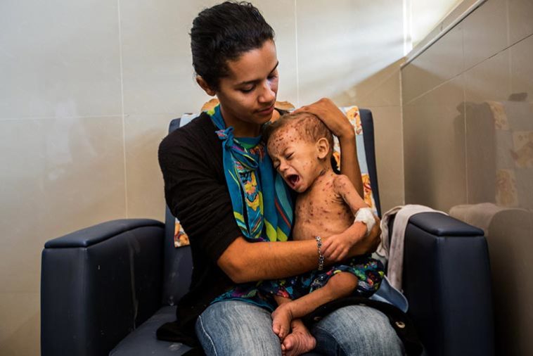 Caritas enciende las alarmas: 11 % de desnutrición infantil en Venezuela